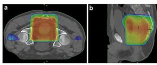 Image result for Radiotherapy Rectal Cancer