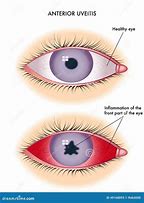 Image result for Uveitis Vision