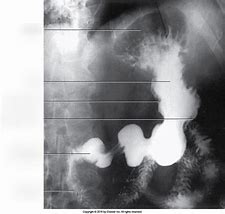 Image result for Stomach in X-ray