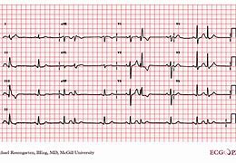 Image result for Premature Atrial Contraction