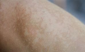 Image result for Dark Pigmentation On Legs