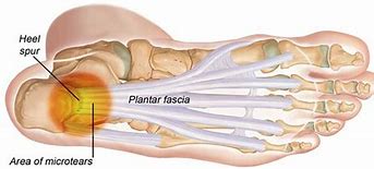 Image result for Plantarfasziitis