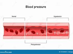 Image result for High Blood Pressure Arteries