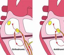 Image result for Atrioventricular Reciprocating Tachycardia