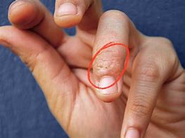 Image result for Eczema Rash On Hands