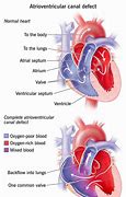 Image result for AV Canal Defect Down Syndrome