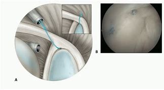 Image result for Scapulothoracic Bursectomy Arthroscopy