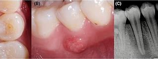 Image result for Mandibular 2nd Pre Molar