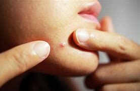 Image result for Acne Under Chin