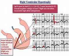 Image result for Right Ventricular Hypertrophy