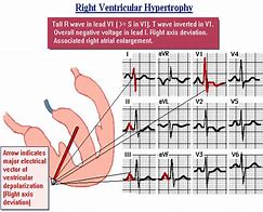 Image result for Right Ventricular Hypertrophy Echo