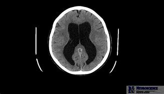 Image result for Brain Shunts Hydrocephalus