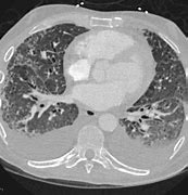 Image result for Lung Ultrasound B Lines Pulmonary Edema