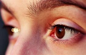 Image result for Enlarged Optic Nerve