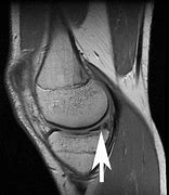 Image result for Arthroscopic Surgery Meniscus