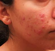 Image result for Pimple Pop