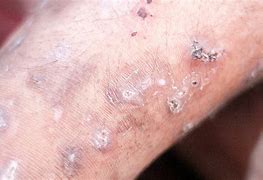 Image result for Mange On Human Skin