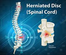 Image result for Lumbar Spine Herniation