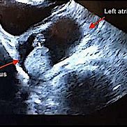 Image result for Left Atrial Appendage Thrombus On Toe