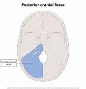 Image result for Extra-Axial Posterior Fossa Mass