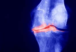 Image result for Patellofemoral Joint Space Narrowing