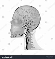 Image result for MRI Angiography