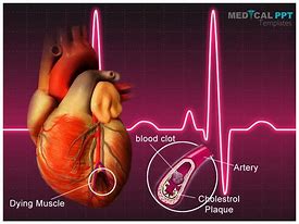 Image result for Heart Tumor/Cancer