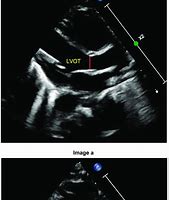 Image result for LVOT Rvot Ultrasound