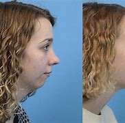 Image result for Chin Indent