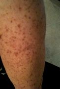 Image result for Dark Age Spots On Legs