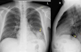 Image result for Left Lower Lobe Pneumonia