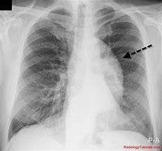 Image result for Aortic Rupture CXR