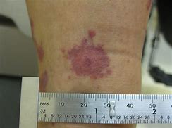 Image result for Dark Red Spots On Skin