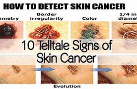 Image result for 5 Warning Signs of Skin Cancer