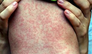 Image result for Rash Diagnosis