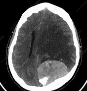 Image result for Meningioma CT Head