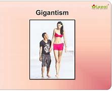 Image result for Example of Gigantism