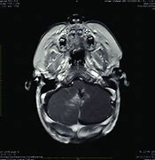 Image result for Medulloblastoma in Child