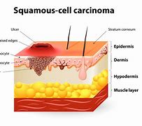 Image result for Squamous and Basal Cell Cancer