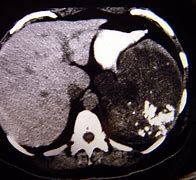 Image result for Spleen Metastasis