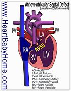 Image result for Atrioventricular Canal Defect Osmosis