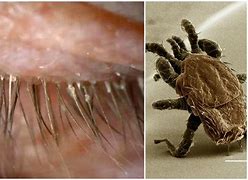 Image result for Eyelash Worms