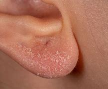 Image result for Ear Eczema