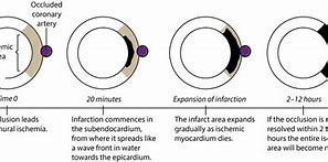 Image result for Acral Ischemia