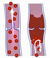 Image result for Thrombose Veineuse Musculaire IRM