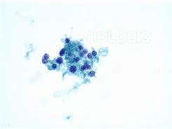 Image result for Adrenal Cytology