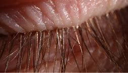 Image result for Head of Eyelaash Mites