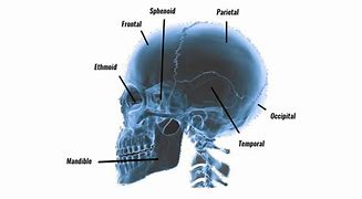 Image result for Skull Fracture