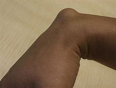 Image result for Cyst On Wrist