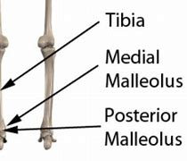 Image result for Lateral Malleolus Fracture Splint